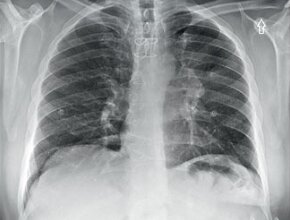 57-year-old male patient with chest pain | Chest X-Ray interpretation